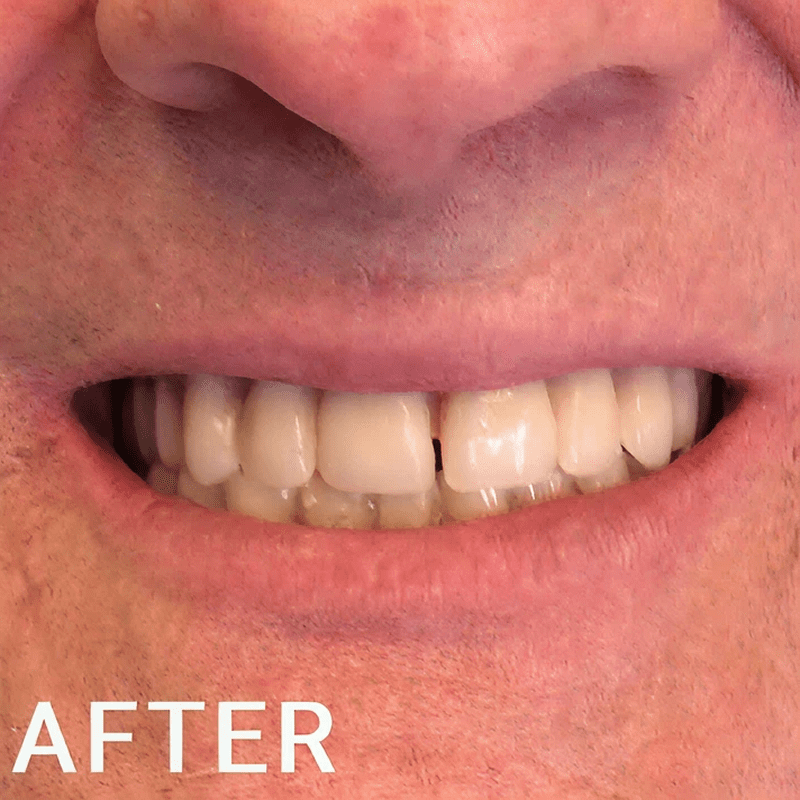 Man's smile after dental treatment.