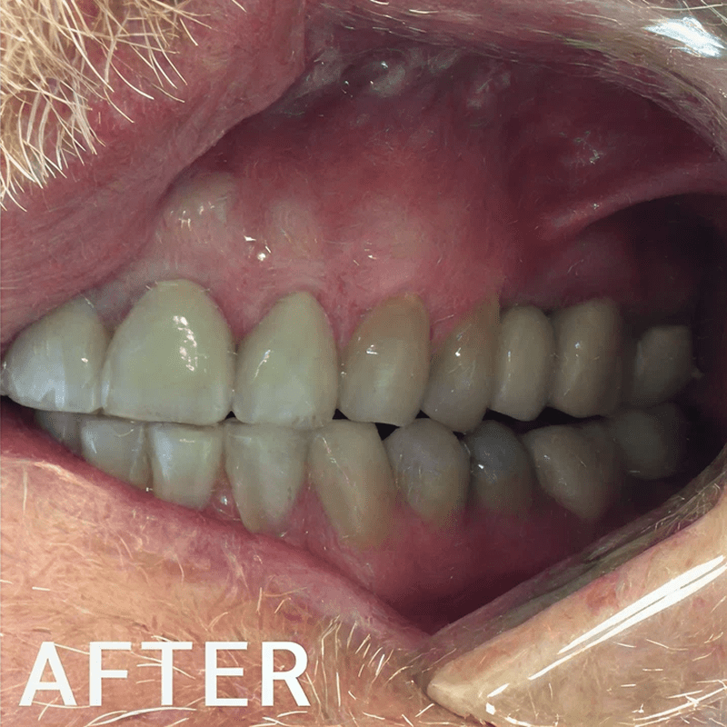 Post-treatment dental results