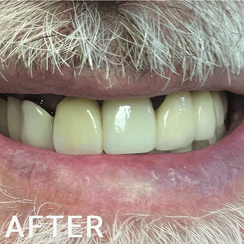 Teeth after dental procedure