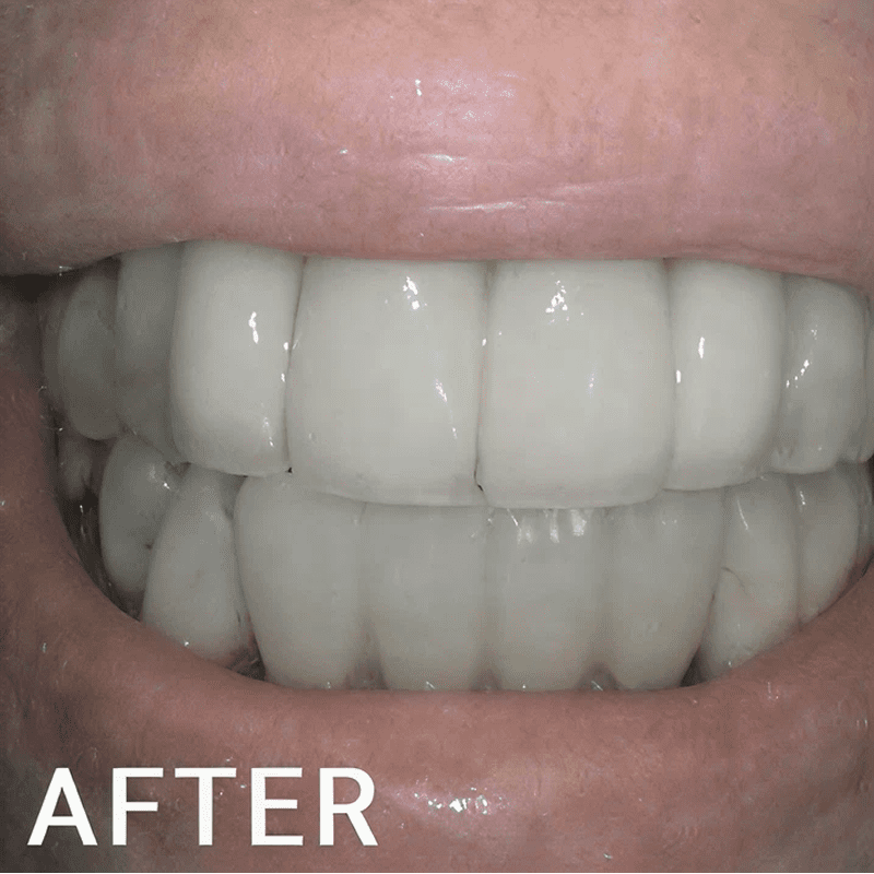 Enhanced teeth appearance after whitening