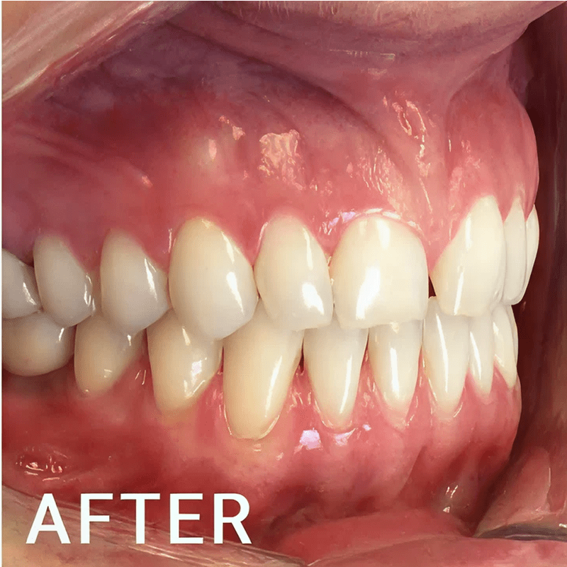 Enhanced smile with aligned teeth