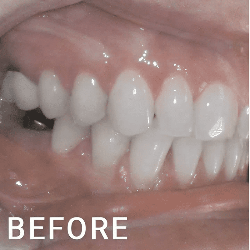 Misaligned teeth close-up view