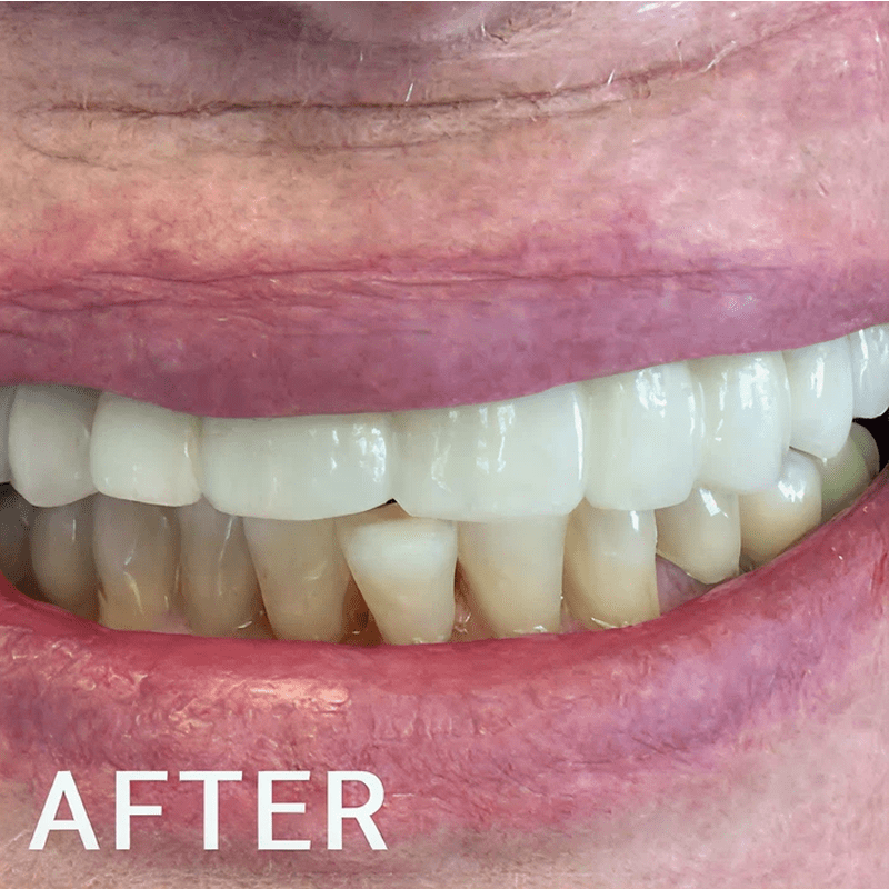 Teeth with fresh veneers after procedure