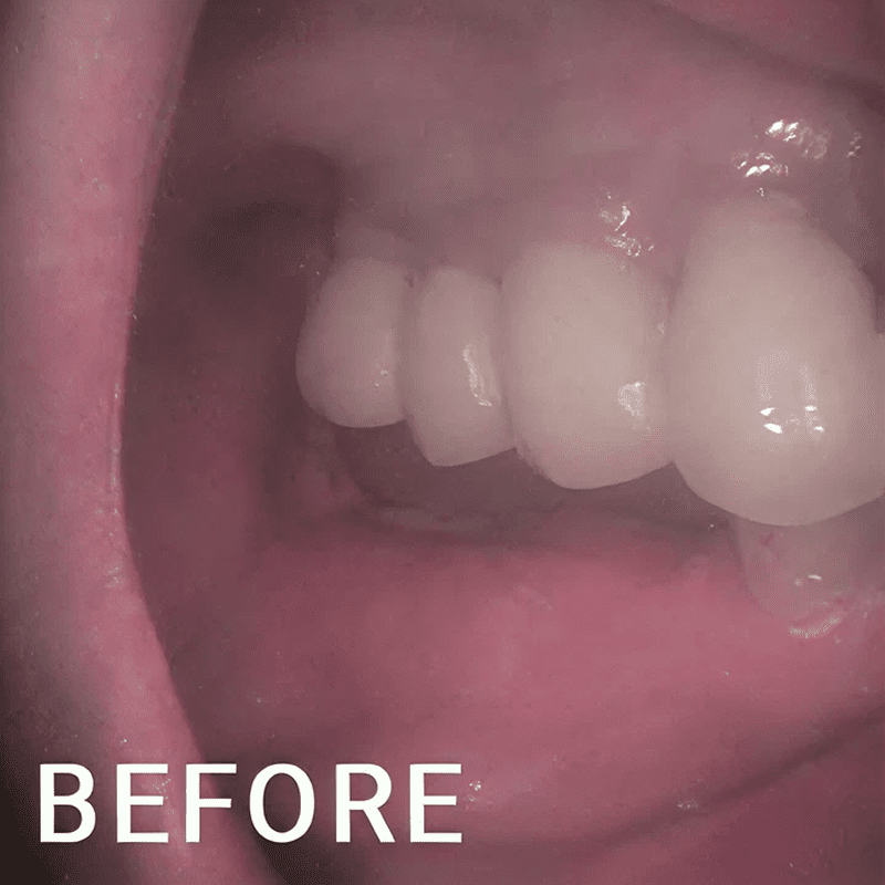 Close-up of teeth before treatment