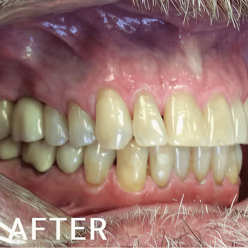 Improved dental alignment after treatment