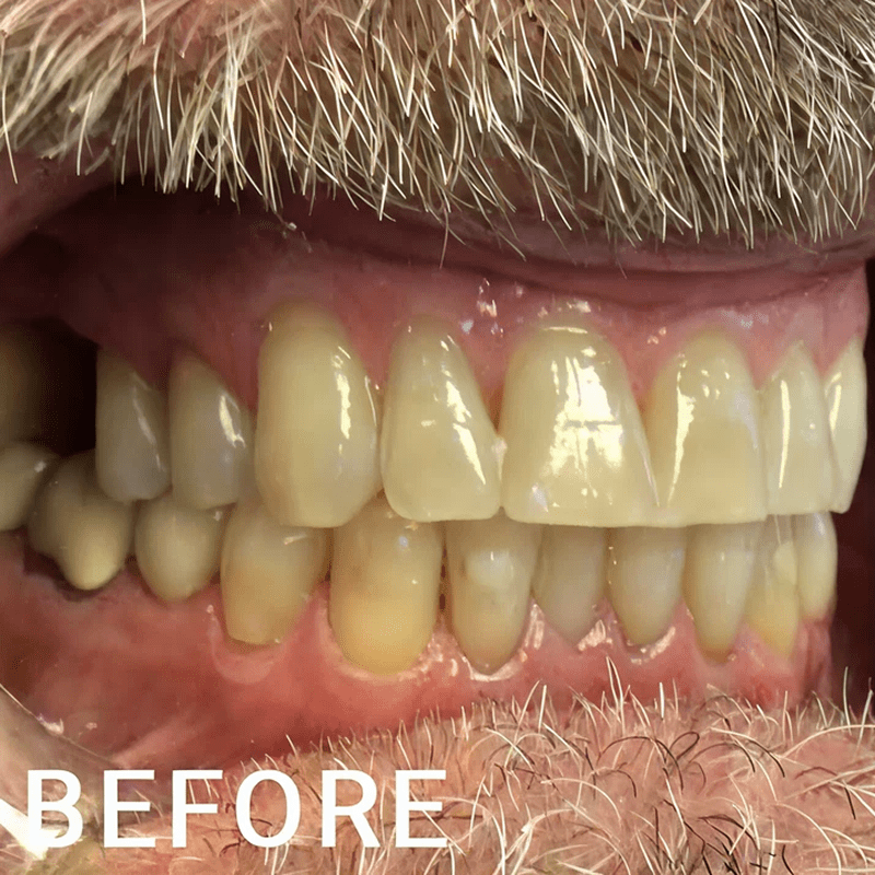 Discolored teeth, needing dental care