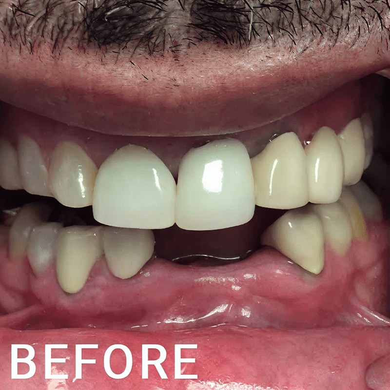 Teeth alignment before orthodontic work